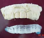 mouthguard2-16